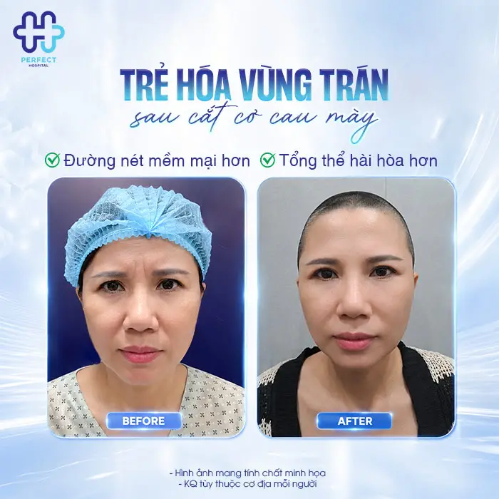 Cắt Cơ Cau Mày Giá Bao Nhiêu? Cập Nhật Chi Phí Mới 2026