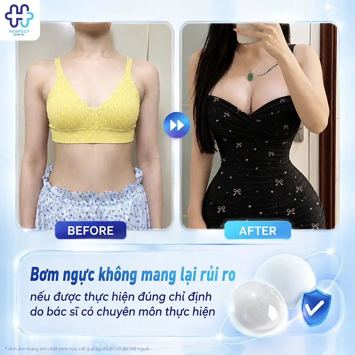 Bơm Ngực Khác Gì Nâng Ngực? Bác Sĩ Giải Đáp Chi Tiết