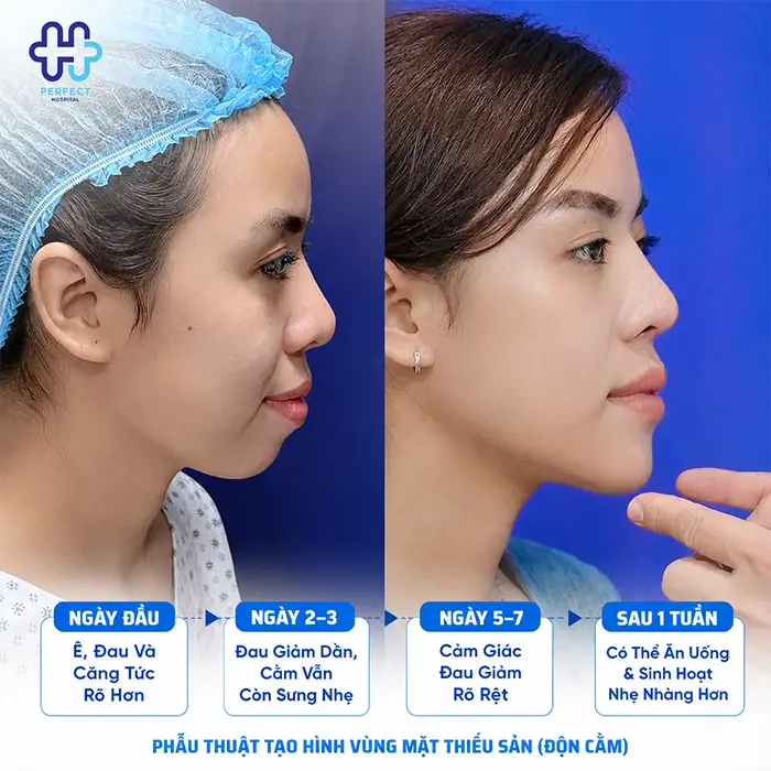 Độn Cằm Có Đau Không? Chuyên Gia Giải Đáp Chi Tiết Từ Quy Trình Đến Hồi Phục