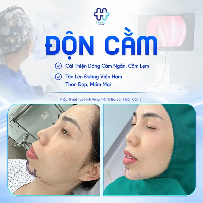 Độn Cằm Có Đau Không? Chuyên Gia Giải Đáp Chi Tiết Từ Quy Trình Đến Hồi Phục