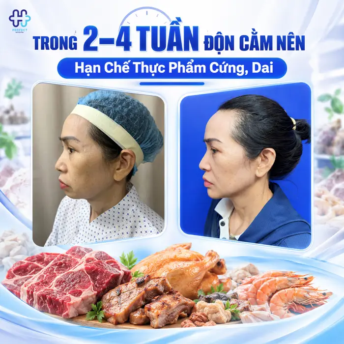 Độn Cằm Kiêng Ăn Gì? Bác Sĩ Chỉ Rõ Thực Phẩm Cần Tránh