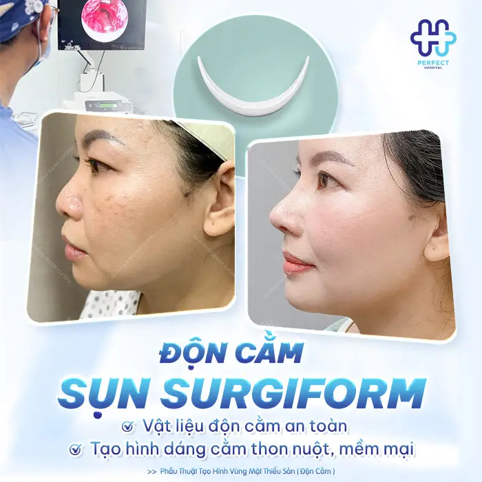 Độn Cằm Sụn Surgiform: Giải Pháp Tạo Đường Nét Cằm Tự Nhiên