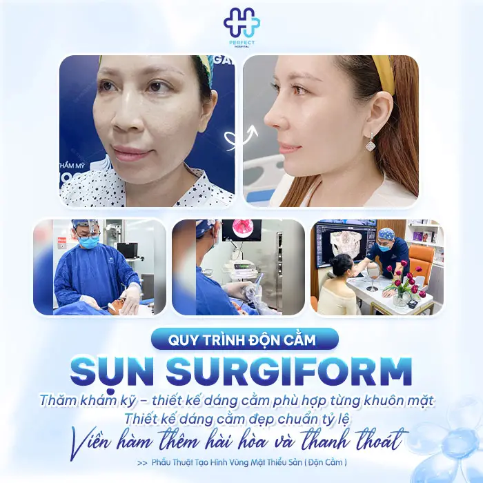 Độn Cằm Sụn Surgiform: Giải Pháp Tạo Đường Nét Cằm Tự Nhiên