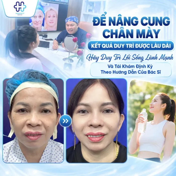 Nâng Cung Chân Mày Giữ Được Bao Lâu? Thời Gian Thực Tế Và 4 Yếu Tố Quyết Định
