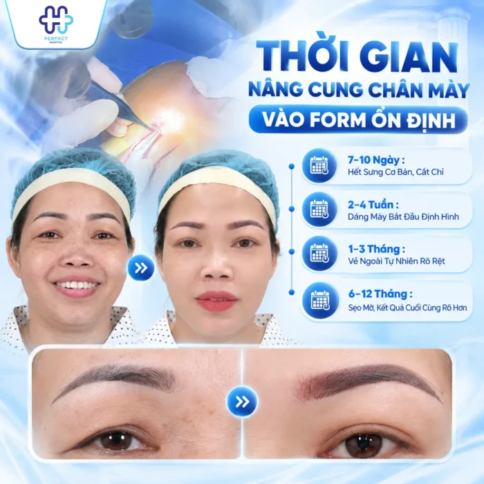 Nâng Cung Chân Mày Giữ Được Bao Lâu? Thời Gian Thực Tế Và 4 Yếu Tố Quyết Định