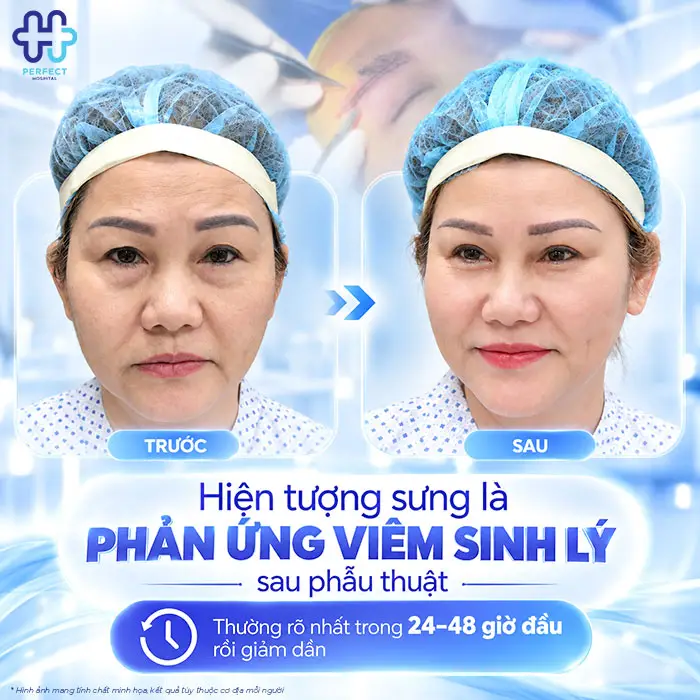 Nâng Cung Chân Mày Bao Lâu Thì Hết Sưng? Giải Đáp Chi Tiết Theo Từng Giai Đoạn