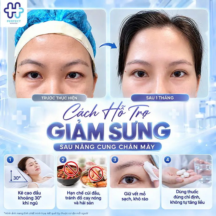 Nâng Cung Chân Mày Bao Lâu Thì Hết Sưng? Giải Đáp Chi Tiết Theo Từng Giai Đoạn