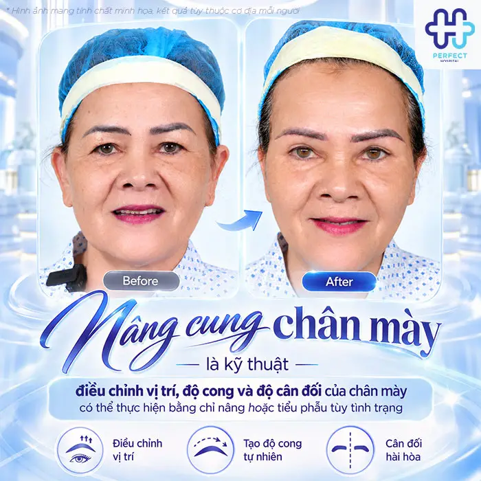 Nâng Cung Chân Mày Có Để Lại Sẹo Không? Giải Đáp Từ A-Z