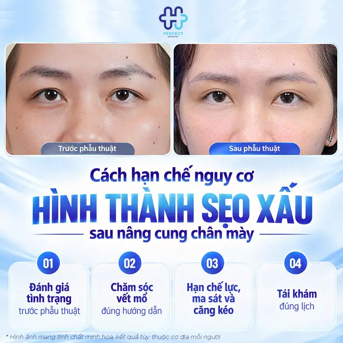Nâng Cung Chân Mày Có Để Lại Sẹo Không? Giải Đáp Từ A-Z