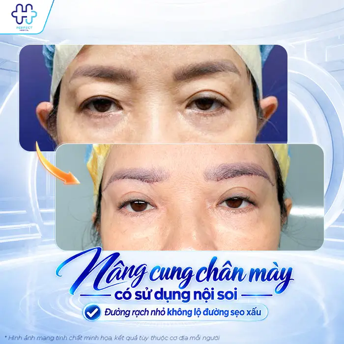 Nâng Cung Chân Mày Có Để Lại Sẹo Không? Giải Đáp Từ A-Z