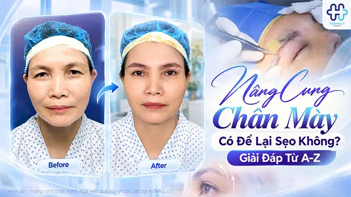 Nâng Cung Chân Mày Có Để Lại Sẹo Không? Giải Đáp Từ A-Z