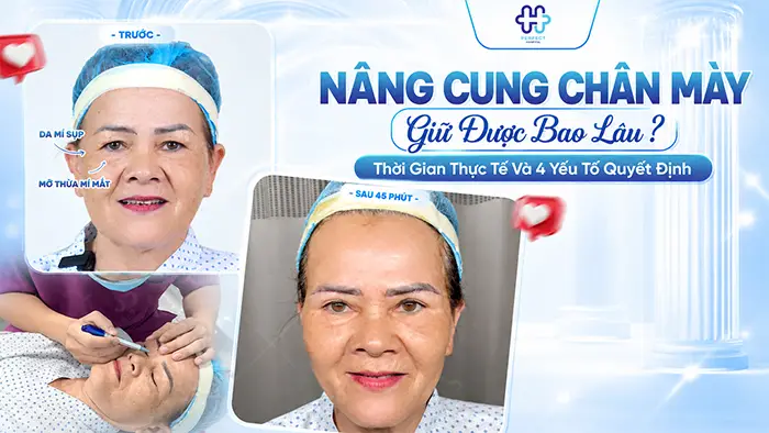 Nâng Cung Chân Mày Giữ Được Bao Lâu? Thời Gian Thực Tế Và 4 Yếu Tố Quyết Định