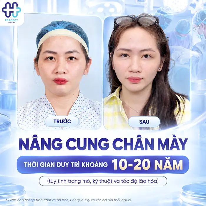Nâng Cung Chân Mày Giữ Được Bao Lâu? Thời Gian Thực Tế Và 4 Yếu Tố Quyết Định