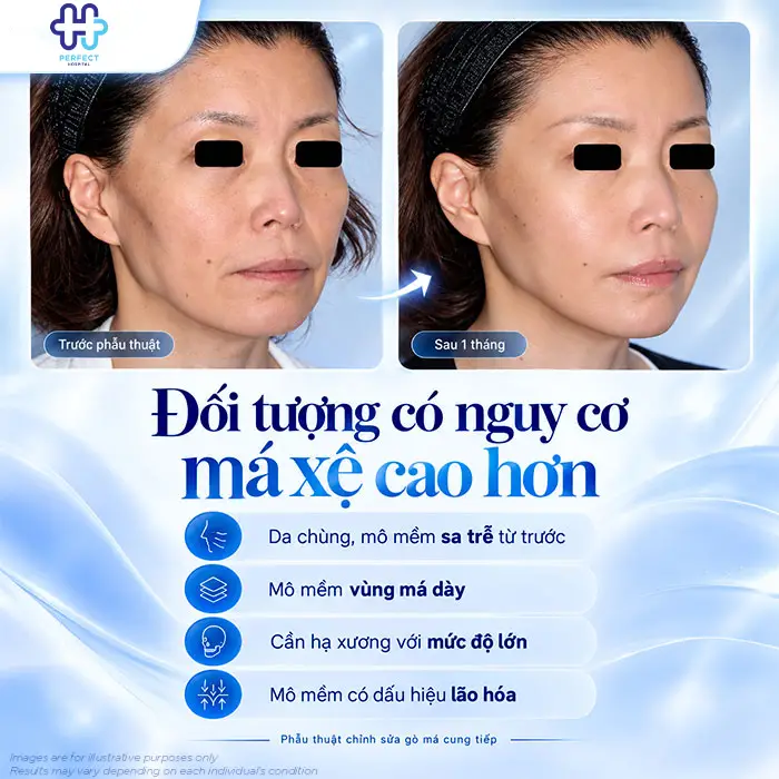 Hạ Gò Má Có Bị Xệ Mặt Không? Bác Sĩ Giải Đáp Trước Khi Phẫu Thuật