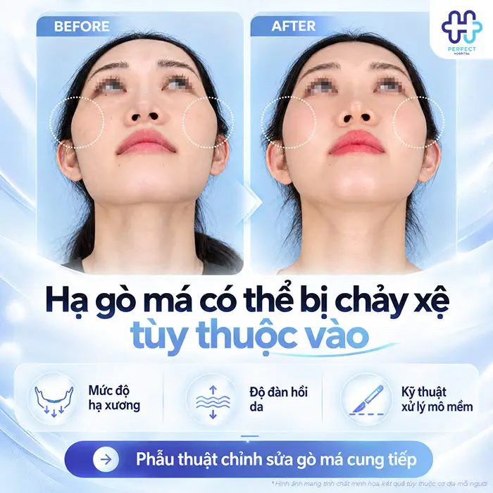 Hạ Gò Má Có Bị Xệ Mặt Không? Bác Sĩ Giải Đáp Trước Khi Phẫu Thuật