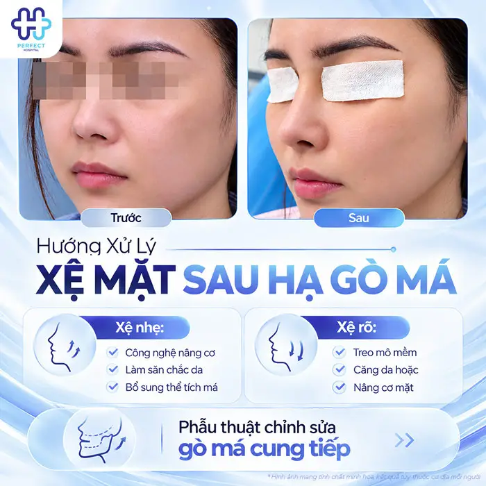 Hạ Gò Má Có Bị Xệ Mặt Không? Bác Sĩ Giải Đáp Trước Khi Phẫu Thuật