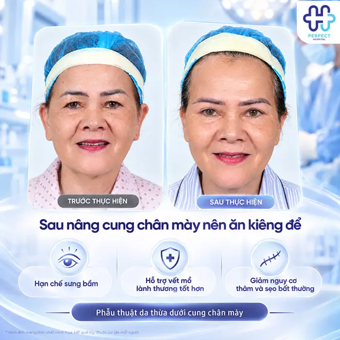 Nâng Cung Chân Mày Kiêng Ăn Gì? Hướng Dẫn Chi Tiết Từ Góc Nhìn Chuyên Khoa